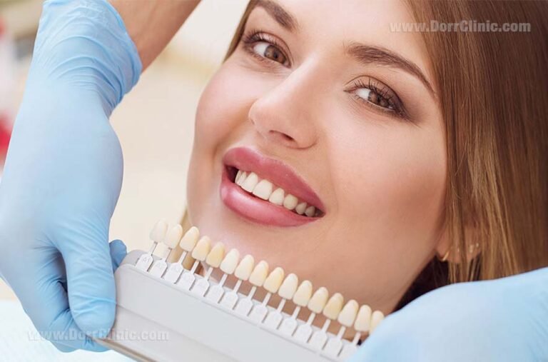 Top Benefits of Dental Crowns in Atlanta