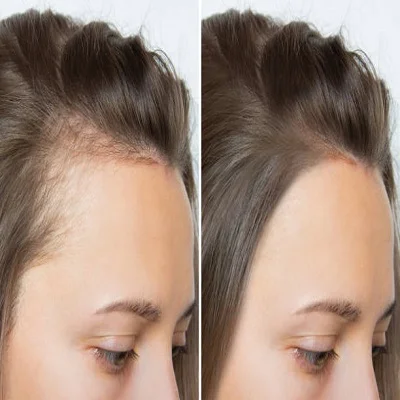Natural vs. Medical Hair Restoration: Pros, Cons, and What Works Best